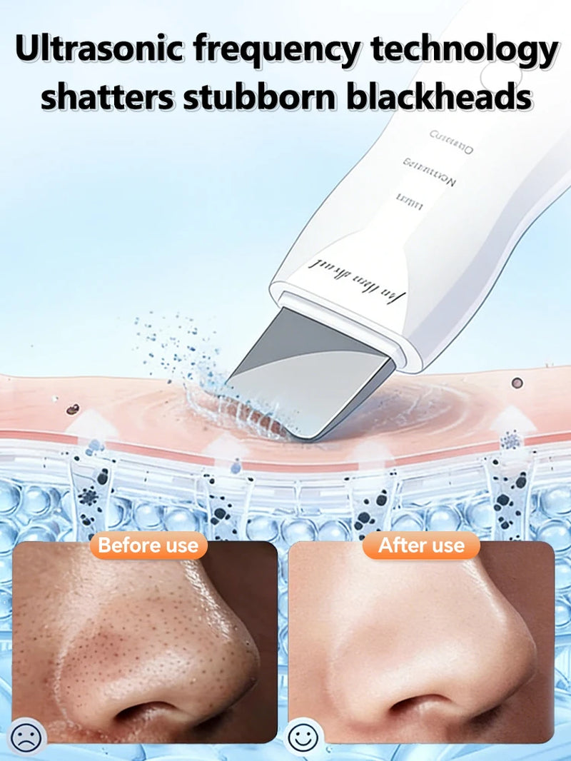 Ultrasonic Skin Scrubber Blackhead Remover Deep Pore Cleaner Facial Cleansing Device Exfoliator