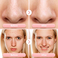 Blackhead Remover Pore Vacuum, USB Rechargeable Face Pore Cleaner Tool